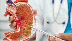 Reflü şikayetleri mide fıtığının habercisi olabilir