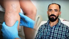 Sedef hastalığı nedeniyle atardamarı yırtıldı