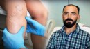 Sedef hastalığı nedeniyle atardamarı yırtıldı