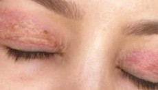 Ucuz estetik pahalıya patladı