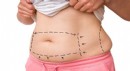 Uygun Liposuction Fiyatlarıyla Kendini Yeniden Yarat!