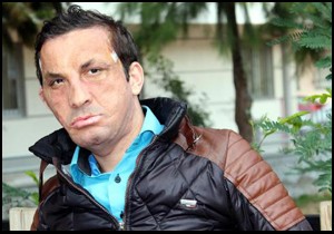 İlk yüz nakilli Uğur Acar, hastanede